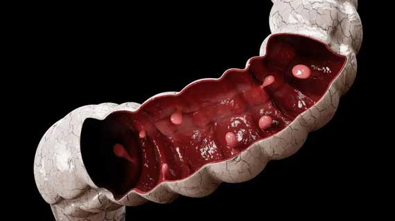 Colon & Rectal Polyps